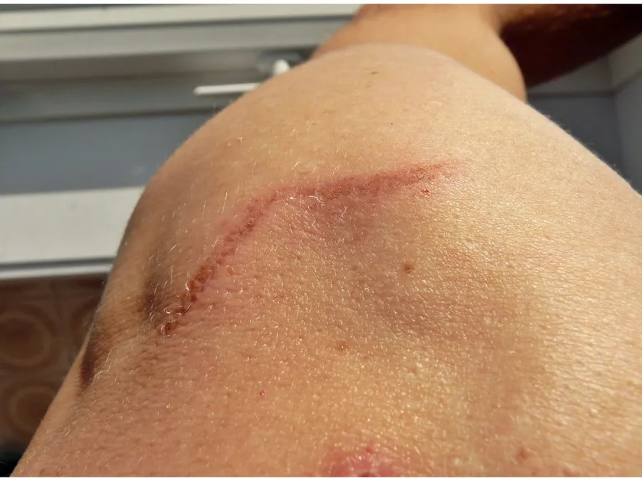 tattoo removal course