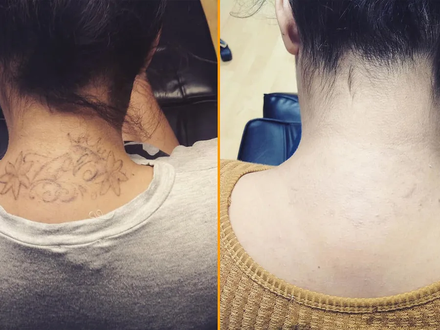 tattoo removal course